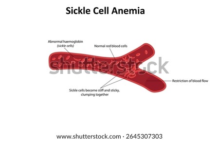 Sickle cell anemia vector illustration