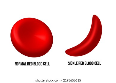 Sickle Cell Disease Difference Normal Red Stock Vector (Royalty Free ...