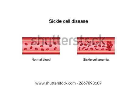 Sickle cell disease. Normal blood and Sickle cell anemia,. Gene mutation. Vector illustration.