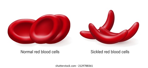 Sickle Cell Disease. Normal Red Blood Cells And Sickled Red Blood Cells.  
