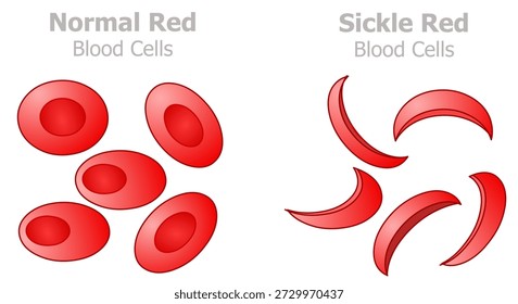Sichelzellkrankheit in Form von Sicheln oder Mondsicheln. Gesunde, normale rote Blutkörperchen sind rund, flexibel und glatt. Illustrationsvektor