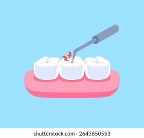 Escalador falciforme com esmalte cárie ilustração projeto vetorial. Conceito de tratamento dentário.