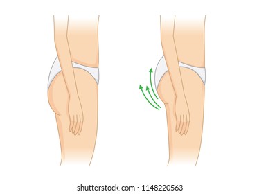 Side view of before and after tightening up buttock. Illustration about body shape and beauty.