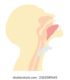 Side view of a human airway anatomy with a tracheostomy tube 