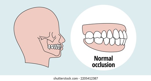 
Side view of teeth after orthodontic treatment, aligned teeth