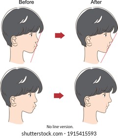 Sideways face of a boy with before and after orthodontics