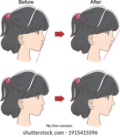 Sideways face of a girl with before and after orthodontics