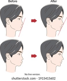 Sideways face of a man with before and after orthodontics
