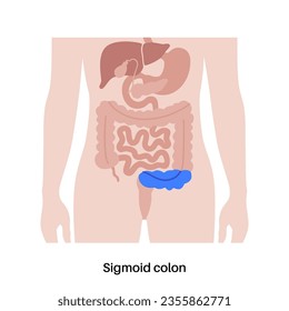 Sigmoid colon poster. Large intestine in the human body. Gastrointestinal disease, diagnostic and treatment in gastroenterology clinic. Digestive tract, examination of bowel vector illustration