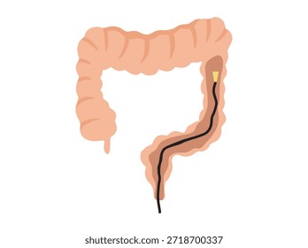 Sigmoidoscopy or Colonoscopy in Intestinal Colon