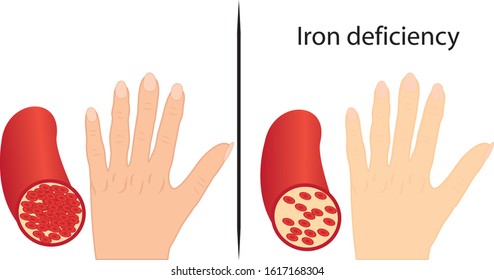 Iron Deficiency Images, Stock Photos & Vectors | Shutterstock