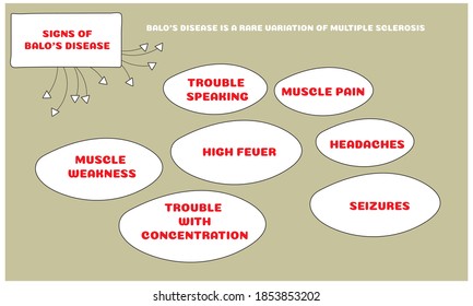 signs of Balo’s disease.Vector illustration for medical journal or brochure. 