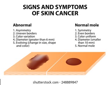 Signs And Symptoms Of Skin Cancer. ABCDE Guideline - A Simple And Easy Way To Check Skin For Suspicious Growths.
