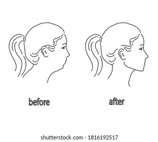 Silhouette of a female face on a white background. Correction of the lower jaw. Vector illustration.