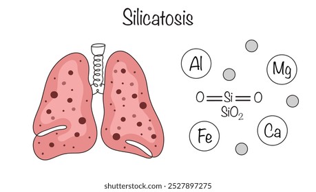 Silicatose. Doença humana do grupo da pneumoconiose, causada por inalação prolongada de pó contendo compostos de ácido silícico com óxidos metálicos. Ilustração vetorial.