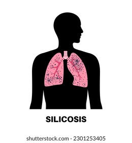 Silicosis anatomical poster. Lung disease, inhaling large amounts of crystalline silica dust. Shortness of breath, chest pain. Breathing problem, illness of respiratory system vector illustration.