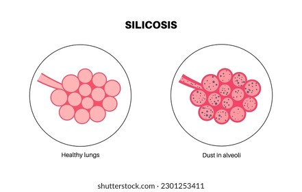 Silicosis anatomical poster. Lung disease, inhaling large amounts of crystalline silica dust. Shortness of breath, chest pain. Breathing problem, illness of respiratory system vector illustration.