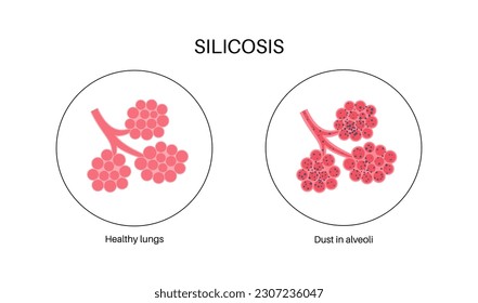 Silicosis anatomical poster. Lung disease, inhaling large amounts of crystalline silica dust. Shortness of breath, chest pain. Breathing problem, illness of respiratory system vector illustration.