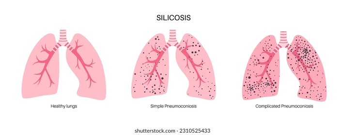 Silicosis anatomical poster. Lung disease, inhaling large amounts of crystalline silica dust. Shortness of breath, chest pain. Breathing problem, illness of respiratory system vector illustration.