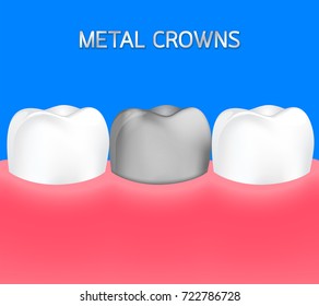 Silver tooth between healthy tooth. Metal crowns, dental care concept. Illustration isolated on blue background.