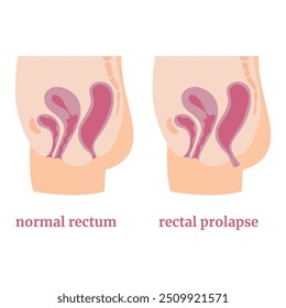 Un diagrama simple de prolapso anal y rectal usando el ejemplo de un cuerpo femenino. Afiche médico. Ilustración vectorial