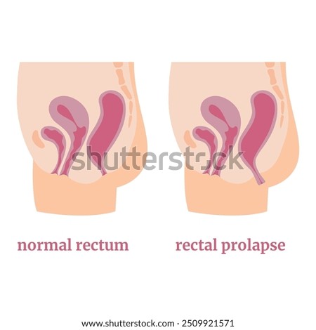 A simple diagram of anal and rectal prolapse using the example of a female body. Medical poster. Vector illustration