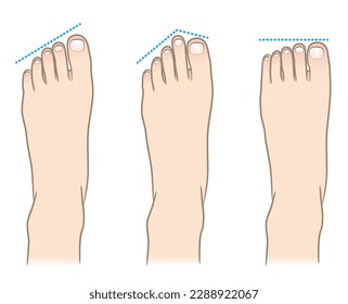 Ilustración simple 3 tipos de dedos de pie