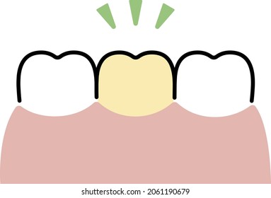 simple illustration of a discolored tooth