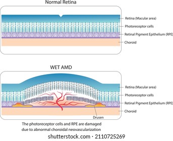 Simple illustration of normal retina and Wet AMD (Age related Macular Diseases). 