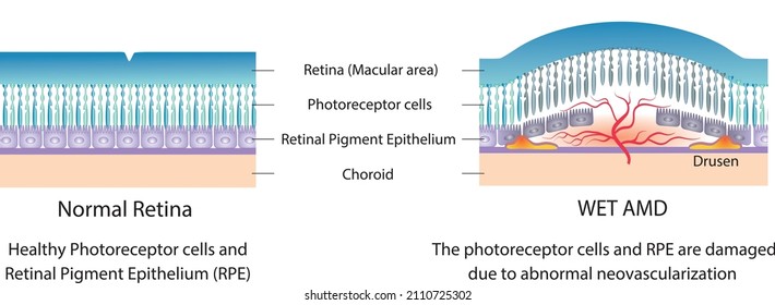 Simple illustration of normal retina and Wet AMD (Age related Macular Diseases). 