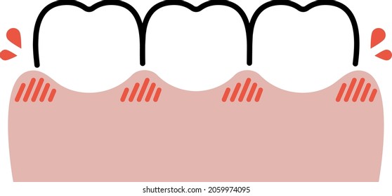 einfache Zeichnung der Gingivitis