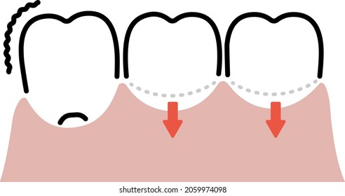 simple line drawing illustration of gum disease