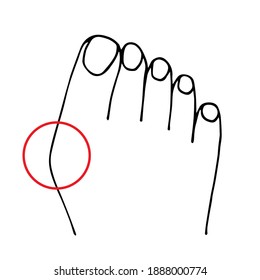 Simple vector black outline drawing. Hallux valgus, deformity of the big toe, curvature of the plus phalangeal joint. Medicine and health, defect, disease.