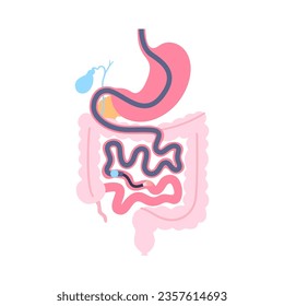 Single balloon enteroscopy procedure. Visualization of the small intestine nonsurgical technique. Gastrointestinal tract problem. Biopsy, polyp removal, bleeding therapy or stent placement flat vector