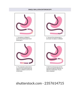 Single balloon enteroscopy procedure. Visualization of the small intestine nonsurgical technique. Gastrointestinal tract problem. Biopsy, polyp removal, bleeding therapy or stent placement flat vector