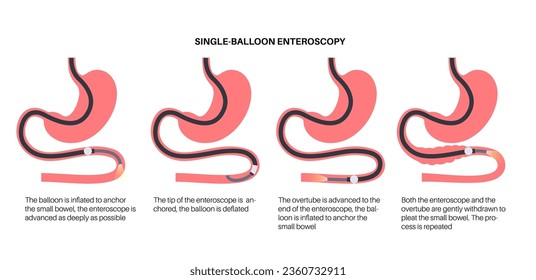 Single balloon enteroscopy procedure. Visualization of the small intestine nonsurgical technique. Gastrointestinal tract problem. Biopsy, polyp removal, bleeding therapy or stent placement flat vector