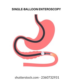 Single balloon enteroscopy procedure. Visualization of the small intestine nonsurgical technique. Gastrointestinal tract problem. Biopsy, polyp removal, bleeding therapy or stent placement flat vector