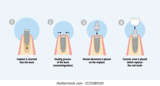 Single dental implant placement process