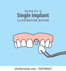 Single Implant Upper Illustration Vector On Blue Background. Dental Concept.