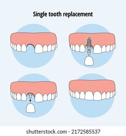 Single  tooth replacement. Dental Implant