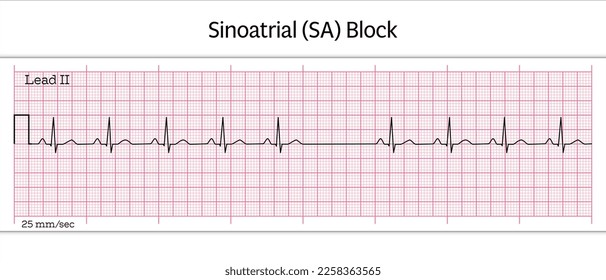 Sinoatrial (SA) Block ECG - 8 zweites ECG-Papier - Vektormedizinische Illustration