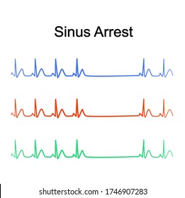 Sinus Arrest or Sinus Pause on Electrocardiogram (ECG) Education.