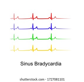 Sinus bradycardia ECG(SB) ,Bradycardia is A heart rate slower than normal heart rate (less than 60 beats per minute),abnormal cardiac rhythm,