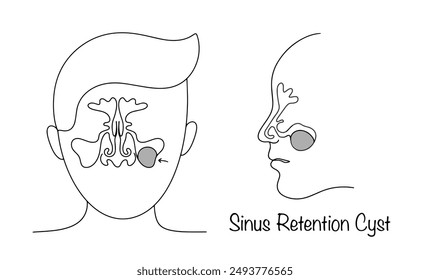 Sinus cyst drawn with lines. Benign sac-like formation in the cavity of the paranasal sinus. Medical vector illustration for different uses.