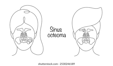 Sinus osteoma. Osteoma of the maxillary and frontal sinuses. A man and a woman with tumors in the sinuses. Vector illustration.