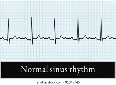 Sinus rhythm on ECG. Vector. Professional information