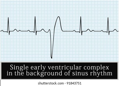 Sinus rhythm on ECG. Vector. Professional information