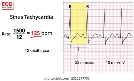 Taquicardia sinusal - ECG Educación con guía de estudio - Vectores médicos Ilustraciones