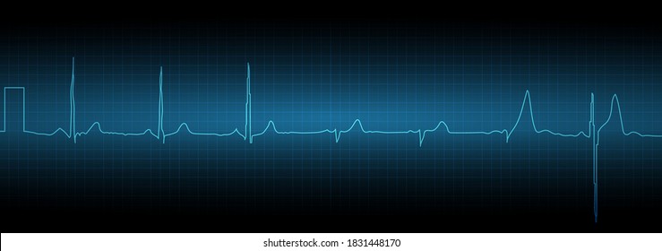 Sinus Tachycardia. Heart Rate Graph. Ekg Icon Wave. Turquoise Color. Stock Vector Illustration.