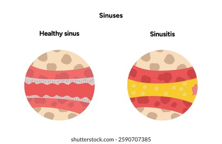 Sinuses anatomy healthy sinus and sinusitis. Nose nasal anatomy. Inflammation Nasal Cavity